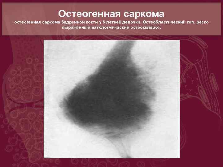 Остеогенная саркома остеогенная саркома бедренной кости у 6 летней девочки. Остеобластический тип. резко выраженный