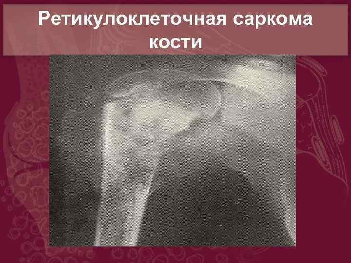 Чем отличается саркома. Остеосаркома кости рентген. Ретикулоклеточная саркома кости. Остеосаркома плечевой кости кт.