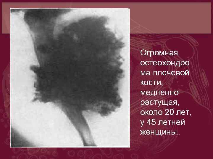 Опухоли костей презентация. Остеохондрома плечевой кости мкб 10 код. Бурая опухоль кость плечо у женщин.