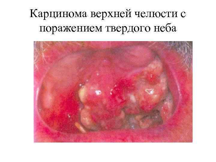 Карцинома верхней челюсти с поражением твердого неба 