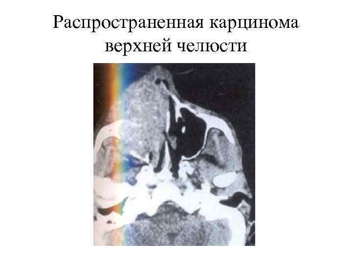 Распространенная карцинома верхней челюсти 