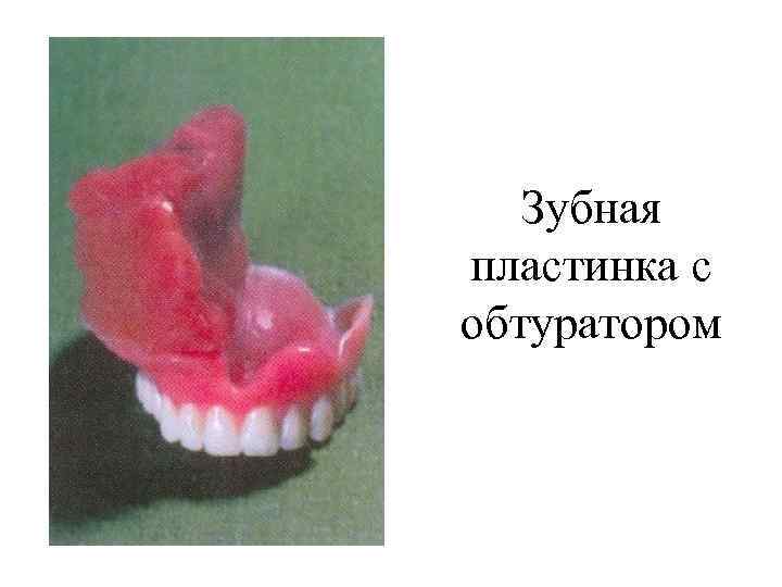Зубная пластинка с обтуратором 
