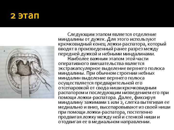 2 этап Следующим этапом является отделение миндалины от дужек. Для этого используют крючковидный конец