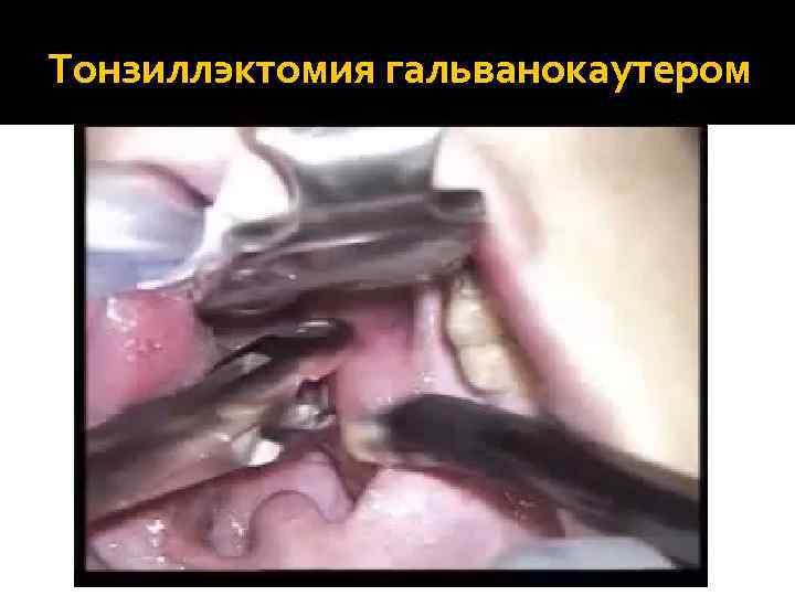Тонзиллэктомия гальванокаутером 