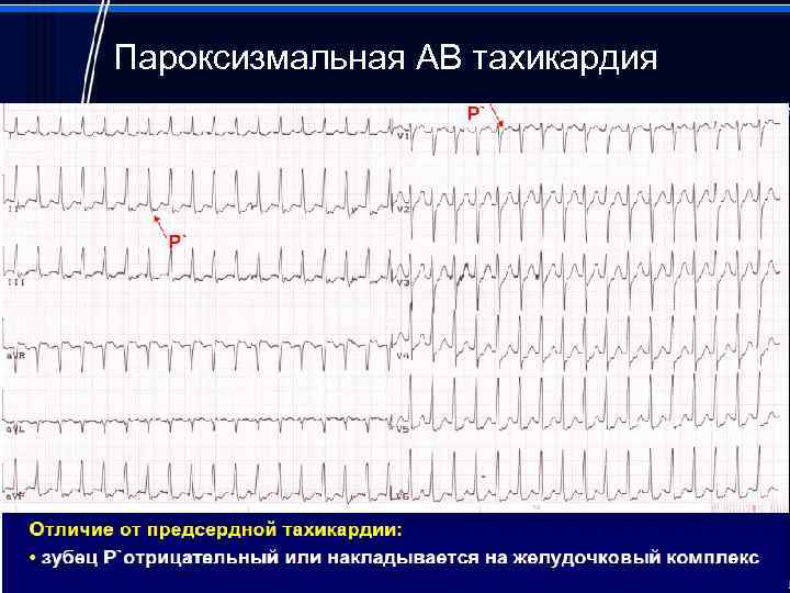 Пароксизмальная тахикардия презентация