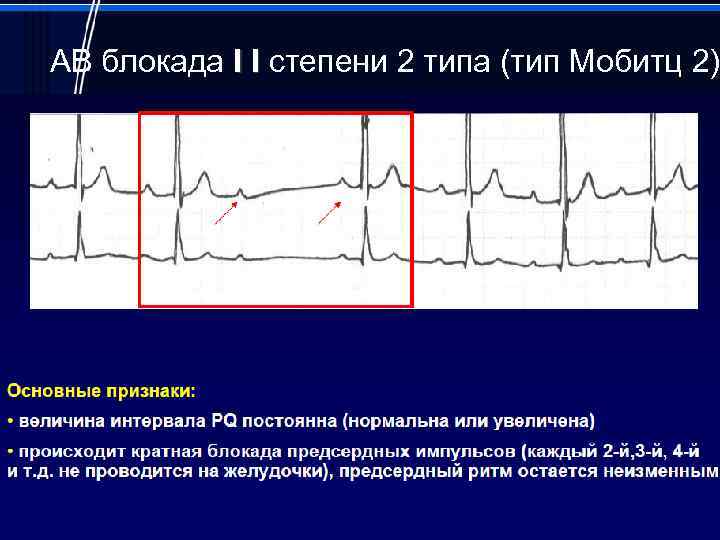 Синоатриальная блокада типы