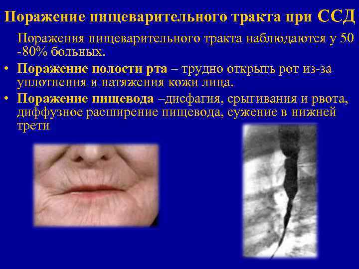 Поражение пищеварительного тракта при ССД Поражения пищеварительного тракта наблюдаются у 50 -80% больных. •