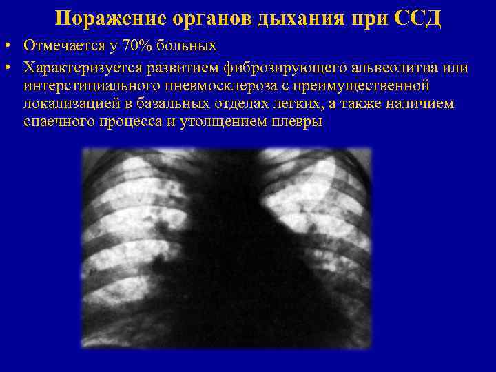 Поражение органов дыхания при ССД • Отмечается у 70% больных • Характеризуется развитием фиброзирующего