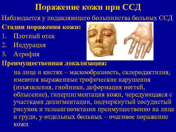 Поражение кожи при ССД Наблюдается у подавляющего большинства больных ССД Стадии поражения кожи: 1.