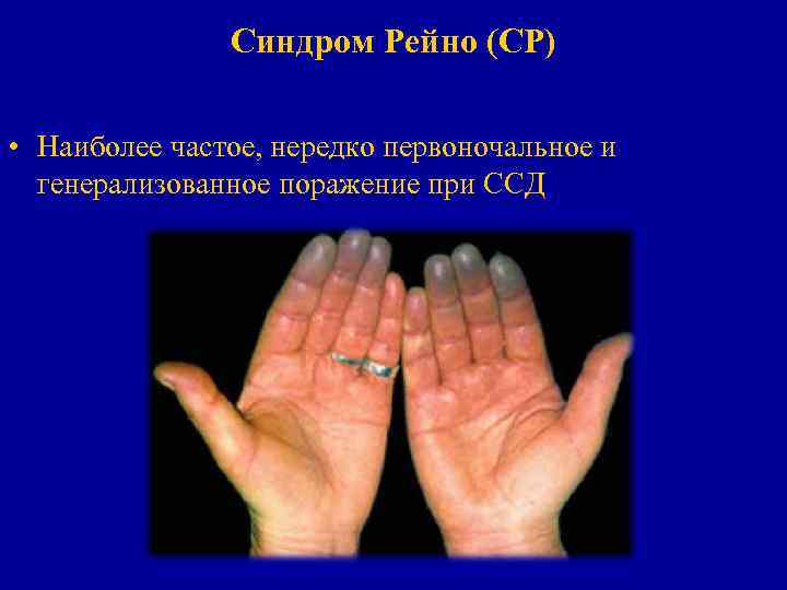 Синдром Рейно (СР) • Наиболее частое, нередко первоночальное и генерализованное поражение при ССД 
