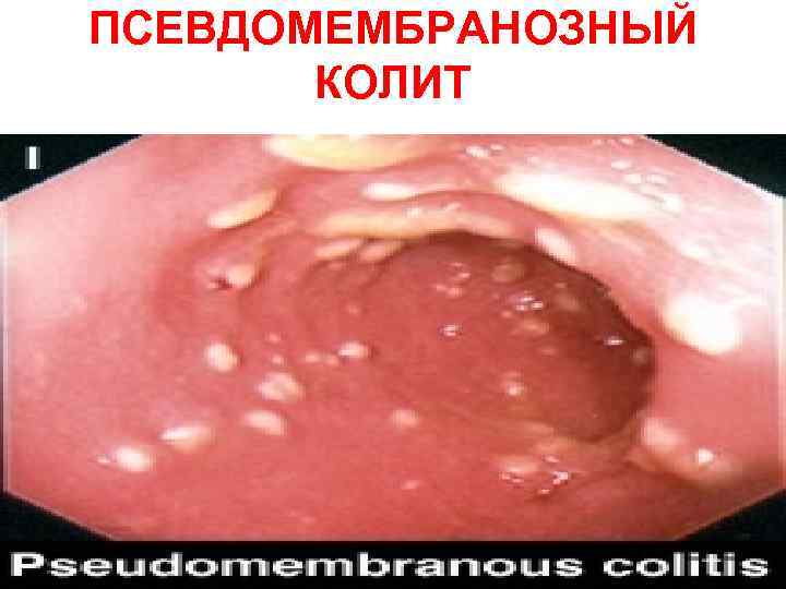 ПСЕВДОМЕМБРАНОЗНЫЙ КОЛИТ 