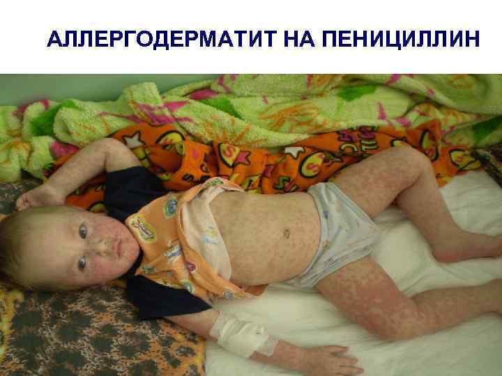 АЛЛЕРГОДЕРМАТИТ НА ПЕНИЦИЛЛИН 
