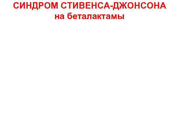 СИНДРОМ СТИВЕНСА-ДЖОНСОНА на беталактамы 