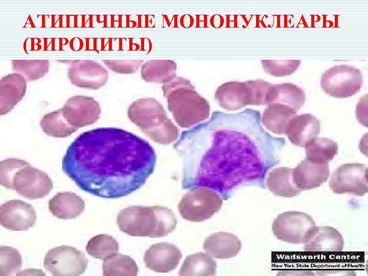 Инфекционный мононуклеоз картина крови