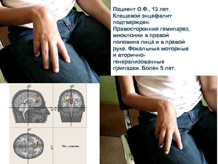 Пациент О. Ф. , 13 лет. Клещевой энцефалит подтвержден. Правосторонний гемипарез, миоклонии в правой