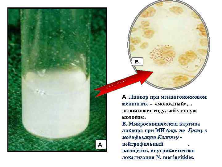В. А. Ликвор при менингококковом менингите - «молочный» , . напоминает воду, забеленную молоком.