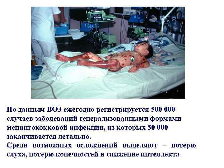 По данным ВОЗ ежегодно регистрируется 500 000 случаев заболеваний генерализованными формами менингококковой инфекции, из