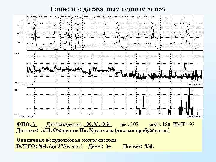 Пациент с доказанным сонным апноэ. ФИО: S Дата рождения: 09. 05. 1964 вес: 107