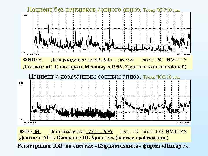Пациент без признаков сонного апноэ. Тренд ЧСС/10 сек. ФИО: У Дата рождения: 10. 09.