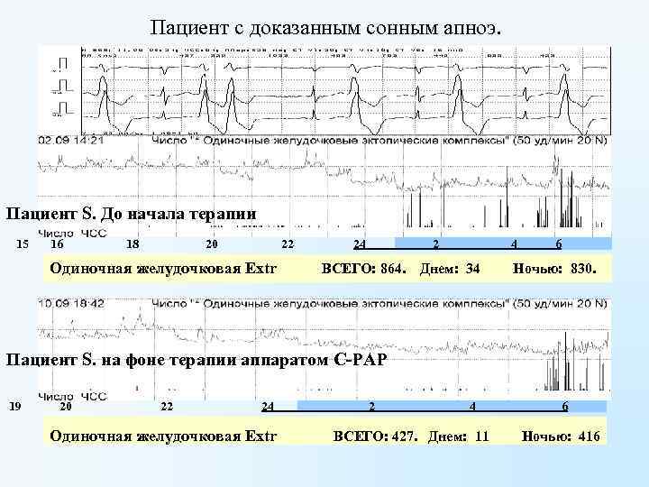 Пациент с доказанным сонным апноэ. Пациент S. До начала терапии 15 16 18 20