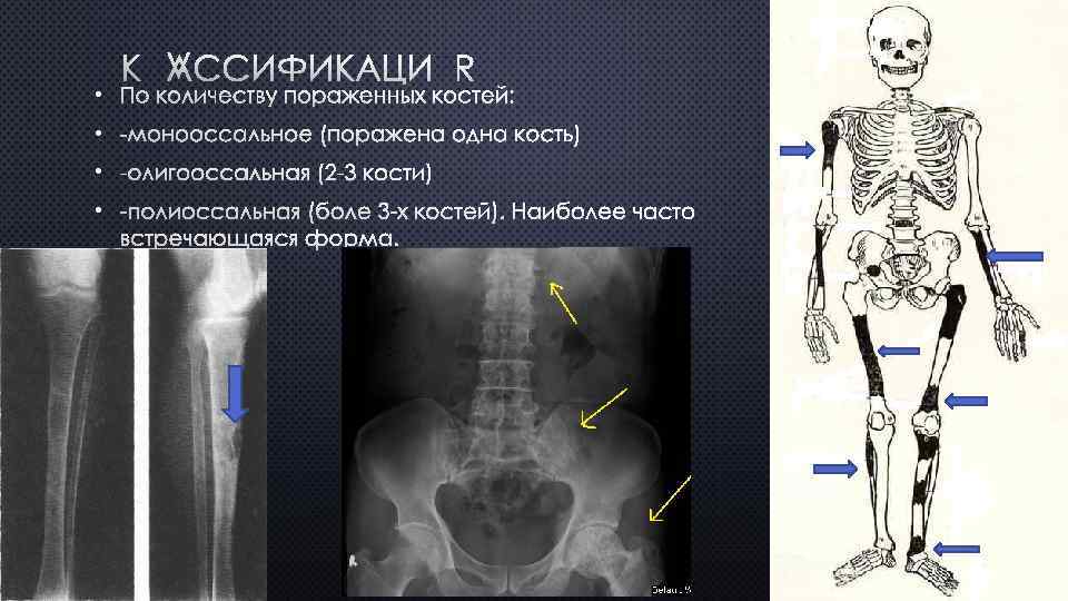 КЛАССИФИКАЦИЯ • ПО КОЛИЧЕСТВУ ПОРАЖЕННЫХ КОСТЕЙ: • -МОНООССАЛЬНОЕ (ПОРАЖЕНА ОДНА КОСТЬ) • -ОЛИГООССАЛЬНАЯ (2