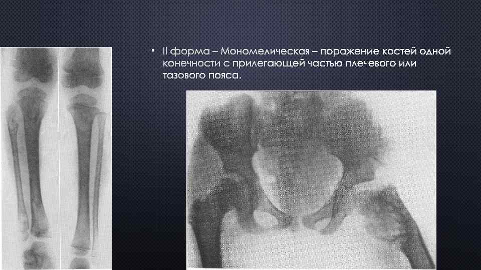  • II ФОРМА – МОНОМЕЛИЧЕСКАЯ – ПОРАЖЕНИЕ КОСТЕЙ ОДНОЙ КОНЕЧНОСТИ С ПРИЛЕГАЮЩЕЙ ЧАСТЬЮ