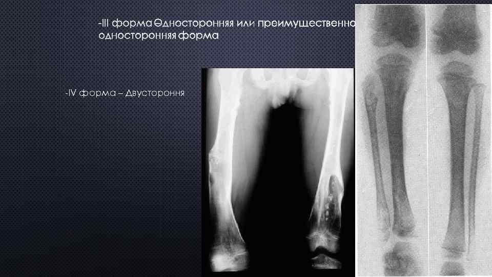 -III ФОРМА – ОДНОСТОРОННЯЯ ИЛИ ПРЕИМУЩЕСТВЕННО ОДНОСТОРОННЯЯ ФОРМА -IV форма – Двустороння 