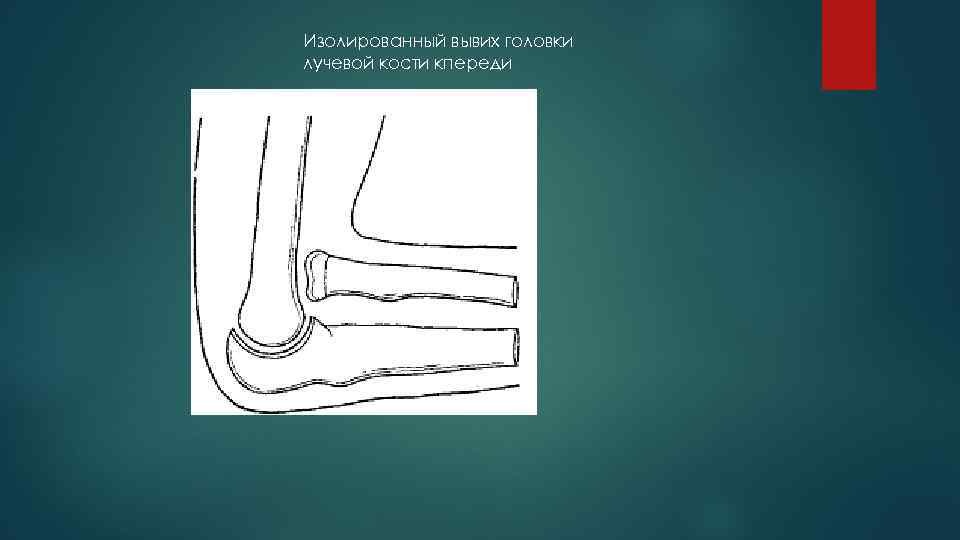 Головка лучевой кости