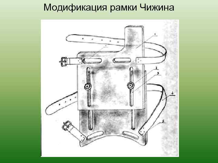 Модификация рамки Чижина 