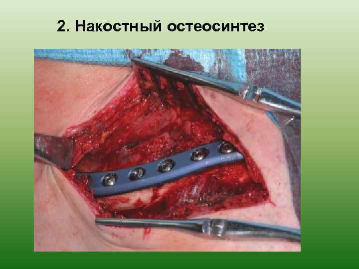 2. Накостный остеосинтез 