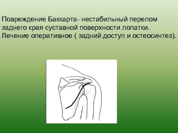 Повреждение Баккарта- нестабильный перелом заднего края суставной поверхности лопатки. Лечение оперативное ( задний доступ