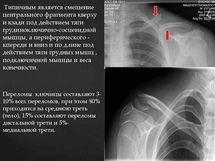  Типичным является смещение центрального фрагмента кверху и кзади под действием тяги грудиноключично-сосцевидной мышцы,