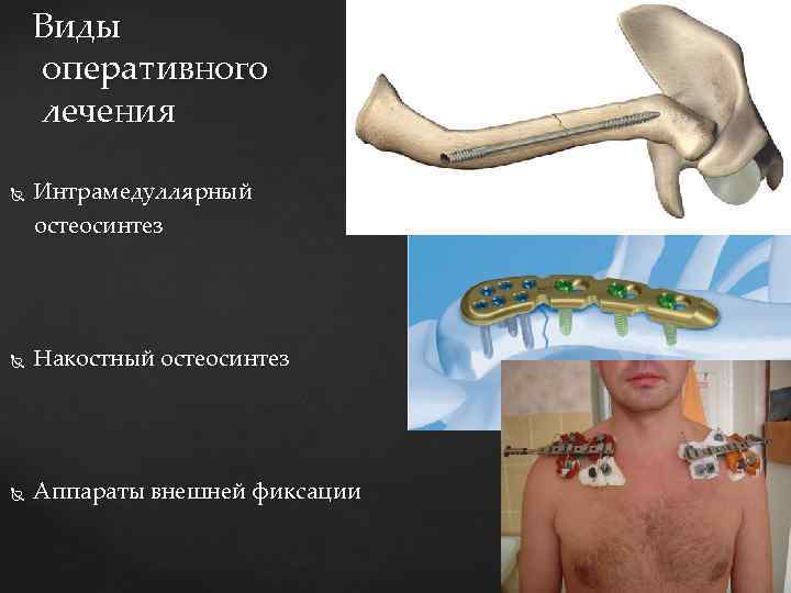 Виды оперативного лечения Интрамедуллярный остеосинтез Накостный остеосинтез Аппараты внешней фиксации 
