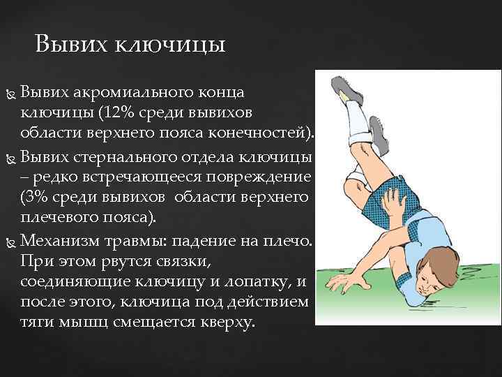 Вывих ключицы Вывих акромиального конца ключицы (12% среди вывихов области верхнего пояса конечностей). Вывих
