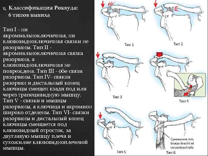  Классификация Роквуда: 6 типов вывиха Тип I - ни акромиальноключичная, ни клювовидноключичная связки
