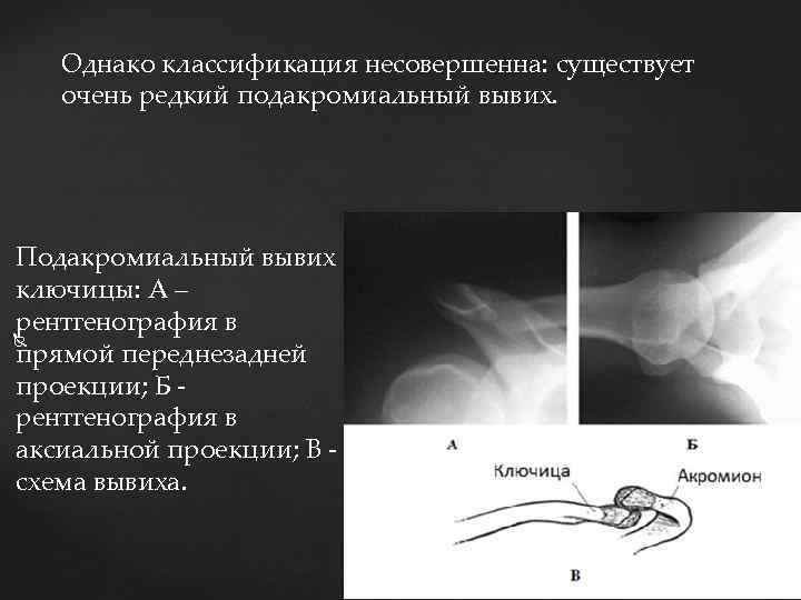 Однако классификация несовершенна: существует очень редкий подакромиальный вывих. Подакромиальный вывих ключицы: А – рентгенография