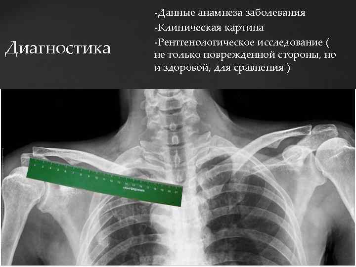 Диагностика -Данные анамнеза заболевания -Клиническая картина -Рентгенологическое исследование ( не только поврежденной стороны, но