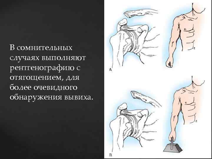 В сомнительных случаях выполняют рентгенографию с отягощением, для более очевидного обнаружения вывиха. 