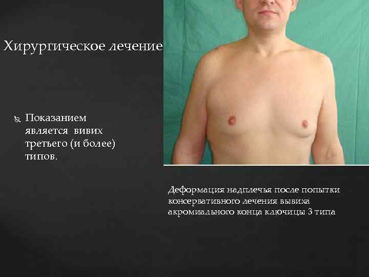 Хирургическое лечение Показанием является вивих третьего (и более) типов. Деформация надплечья после попытки консервативного