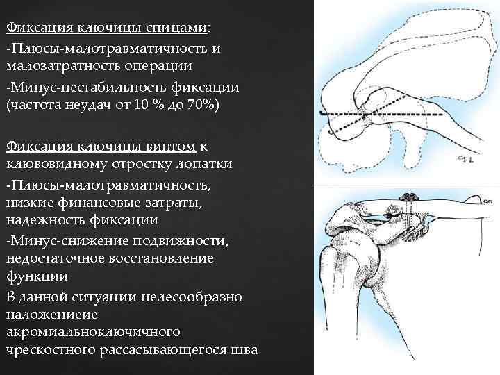 Фиксация ключицы спицами: -Плюсы-малотравматичность и малозатратность операции -Минус-нестабильность фиксации (частота неудач от 10 %