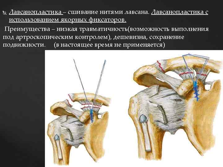 Лавсанопластика – сшивание нитями лавсана. Лавсанопластика с использованием якорных фиксаторов. Преимущества – низкая травматичность(возможность