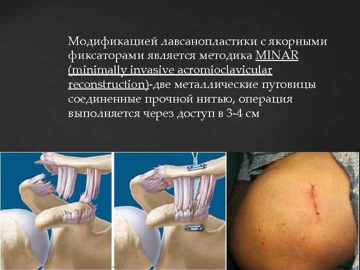 Модификацией лавсанопластики с якорными фиксаторами является методика MINAR фиксаторами является методика (minimally invasive acromioclavicular
