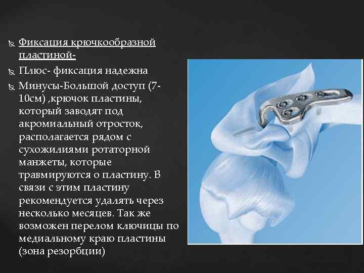  Фиксация крючкообразной пластиной. Плюс- фиксация надежна Минусы-Большой доступ (710 см) , крючок пластины,