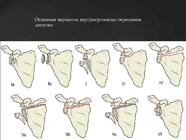 Основные варианты внутрисуставных переломов лопатки 