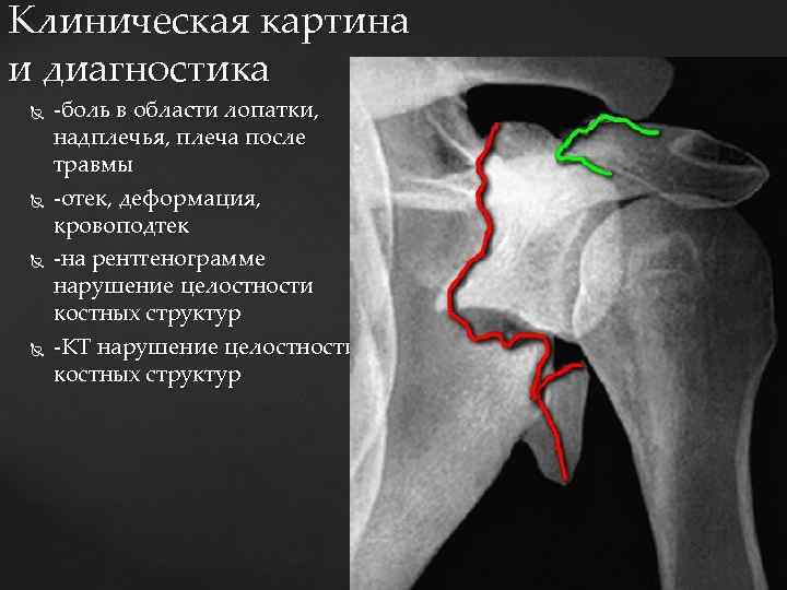 Клиническая картина и диагностика -боль в области лопатки, надплечья, плеча после травмы -отек, деформация,