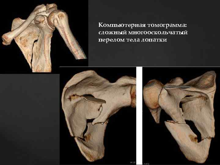 Компьютерная томограмма: сложный многооскольчатый перелом тела лопатки 