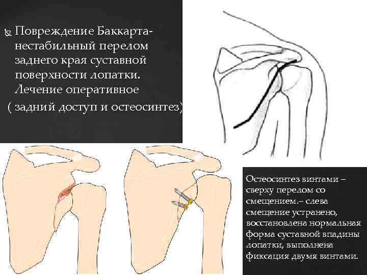 Повреждение Баккарта- нестабильный перелом заднего края суставной поверхности лопатки. Лечение оперативное ( задний доступ