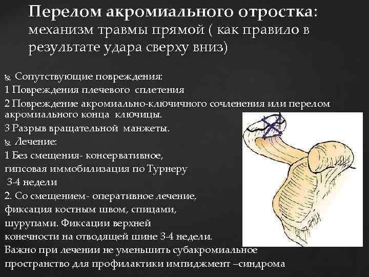 Перелом акромиального отростка: механизм травмы прямой ( как правило в результате удара сверху вниз)