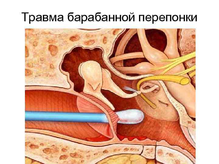 Травма барабанной перепонки 