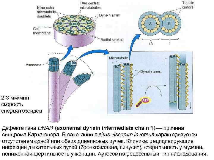 2 -3 мм/мин скорость сперматозоидов Дефекта гена DNAI 1 (аxonemal dynein intermediate chain 1)